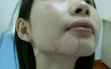 办公室白癜风患者怎么缓解干燥？