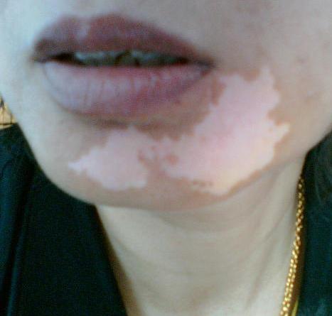 女性脸上白癜风出现有哪些原因