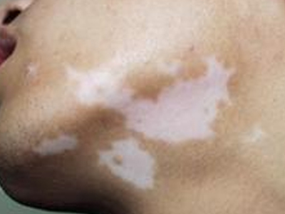 男性患上白癜风会遭到哪些危害