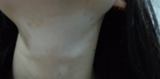 生活中哪些因素成为了白癜风病因