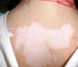 白瘢风的治疗方法具体有哪些 白瘢风的治疗方法具体有哪些.jpg