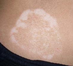 儿童患上白癜风要注意哪些事项 儿童患上白癜风要注意哪些事项.jpg