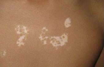 跟白癜风接触会传染吗 跟白癜风接触会传染吗.jpg