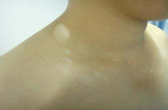 白癜风会不会对人的心理产生影响 白癜风会不会对人的心理产生影响.jpg