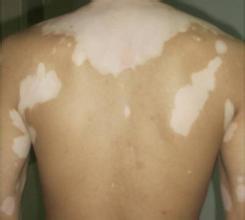 为什么男性会患白癜风 为什么男性会患白癜风.jpg