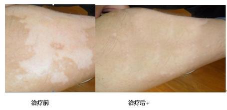 成人手部白癜风的护理常识到底有哪些呢 成人手部白癜风的护理常识到底有哪些呢.jpg